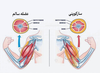 عوامل-بیماری-سارکوپنیا.jpg